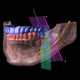 インプラント・下顎管までの干渉チェック