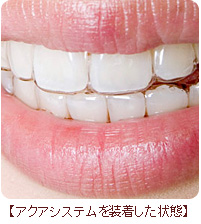 写真：尼崎ガーデン歯科（矯正歯科）のアクアシステムを装着した状態