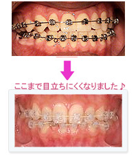 写真：尼崎ガーデン歯科（矯正歯科）の唇側矯正治療