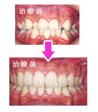 写真：尼崎ガーデン歯科（矯正歯科）のスピード矯正治療