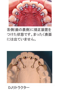 写真：尼崎ガーデン歯科（矯正歯科）の舌側矯正治療