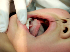 舌小帯切除術